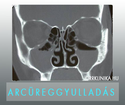ARCUREGGYULLADAS CT