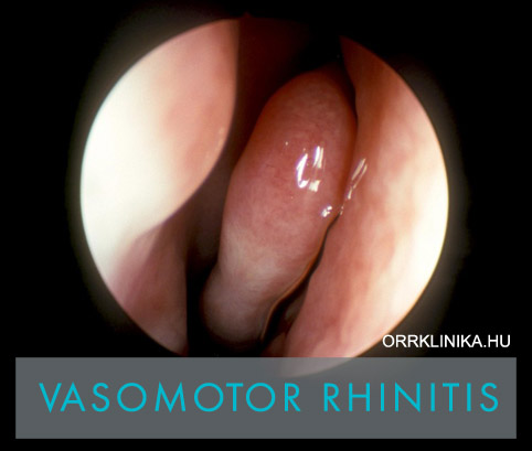 Vasomotor Rhinitis NATHA