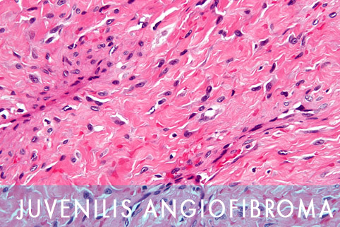 juvenilis angiofibroma szovettan