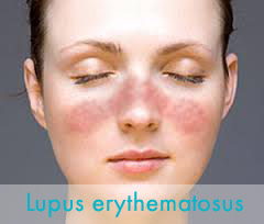 Lupus erythematosus ízületi fájdalom. SLE - szisztémás lupus erythematosus - Immunközpont