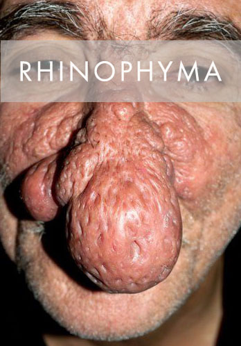 rhinophyma alkoholos orr
