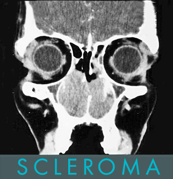 orr rhinoscleroma scleroma
