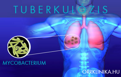pulmonalis tuberkulózis kezelése cukorbetegséggel