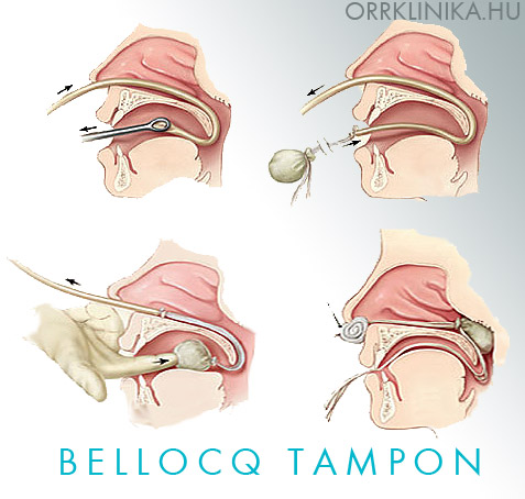 Bellocq tampon orrverzes