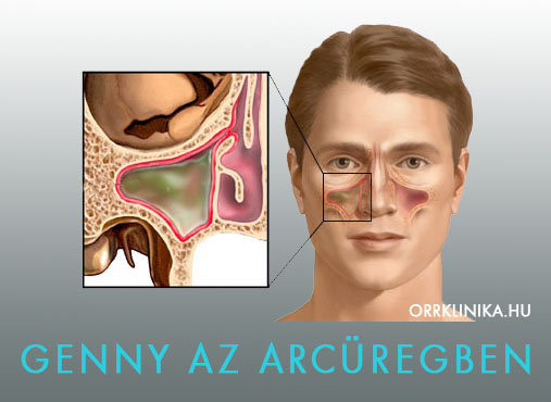 Heveny, akut arcüreggyulladás (sinusitis maxillaris acuta)
