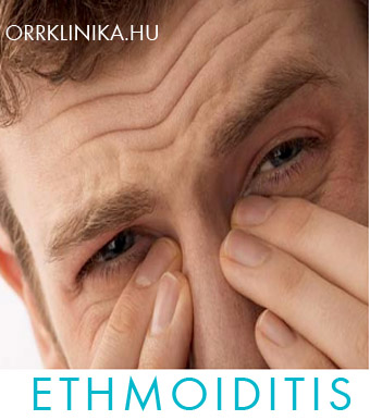 ethmoiditis rostasejt gyulladas